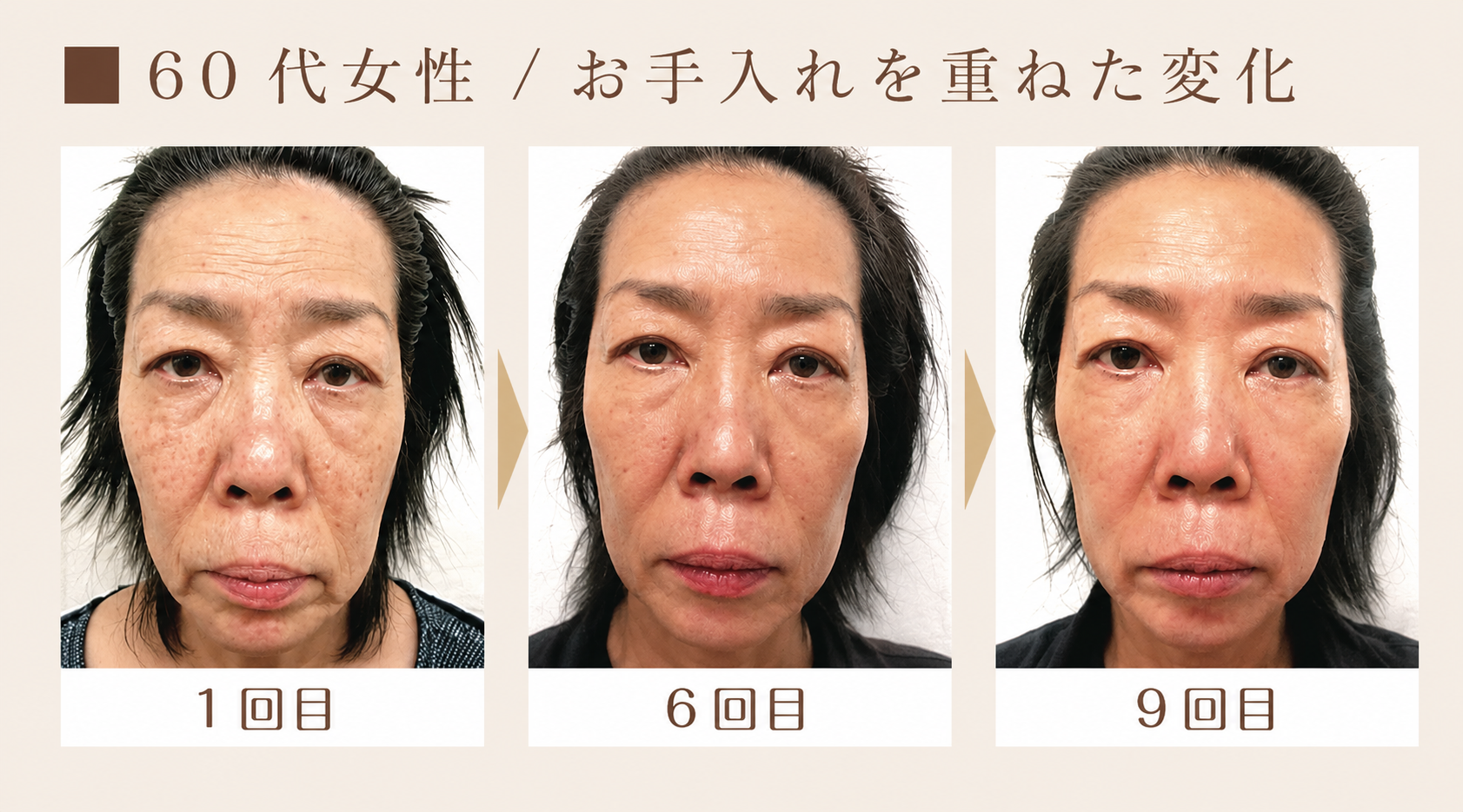 リブセラを使ったフェイシャルを重ねた60代女性の変化（1回目・6回目・9回目）